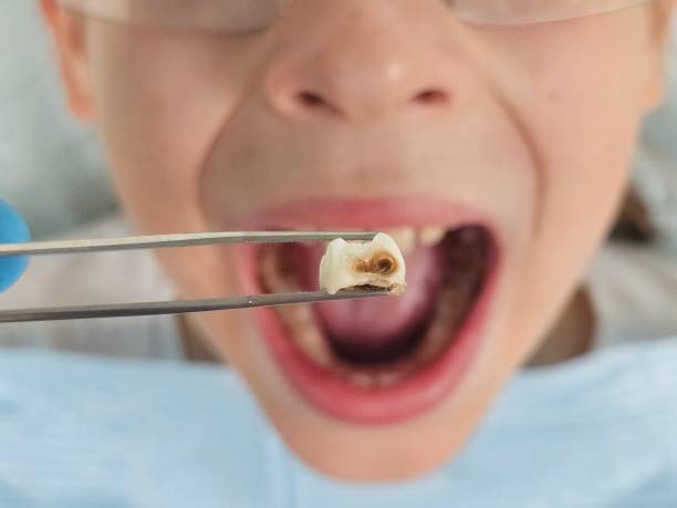 Best Emergency Dental Care for Broken or Chipped Teeth in Shillington, PA